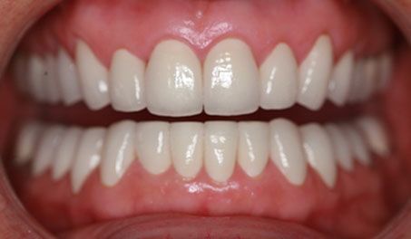 straight teeth after photo