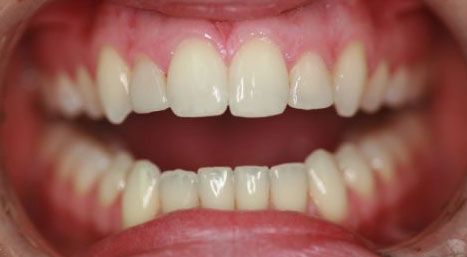 before teeth whitening