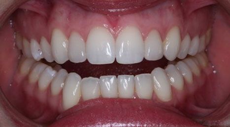 after teeth whitening