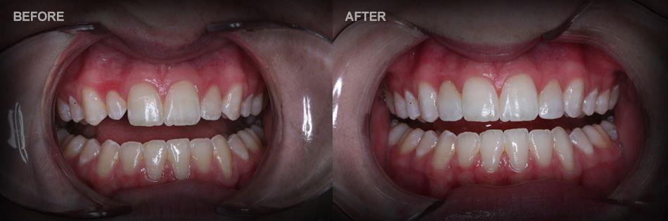 Before and after images of a dental bonding patient. 