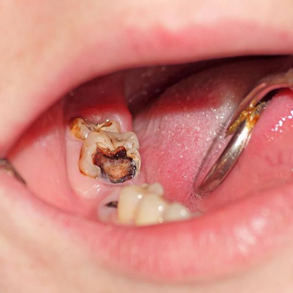 decayed tooth