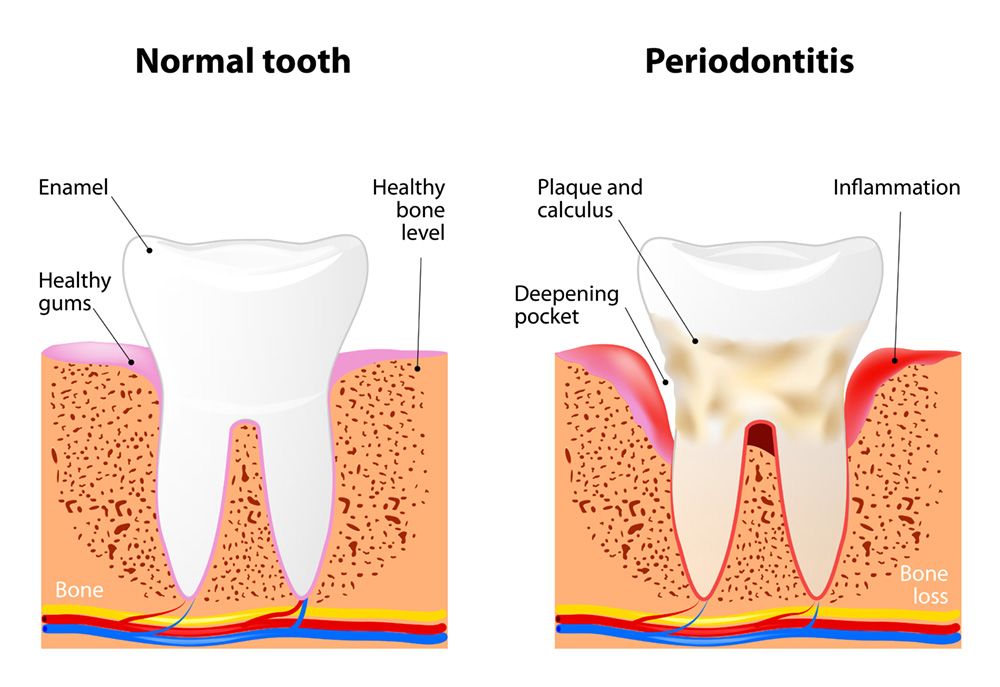 Illustration of a healthy tooth and gums and one suffering from periodontitis